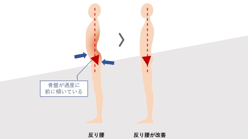 反り腰と骨盤の図解