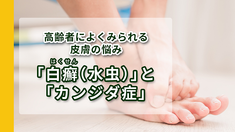 高齢者によくみられる皮膚の悩み：「白癬（水虫）」と「カンジダ症」