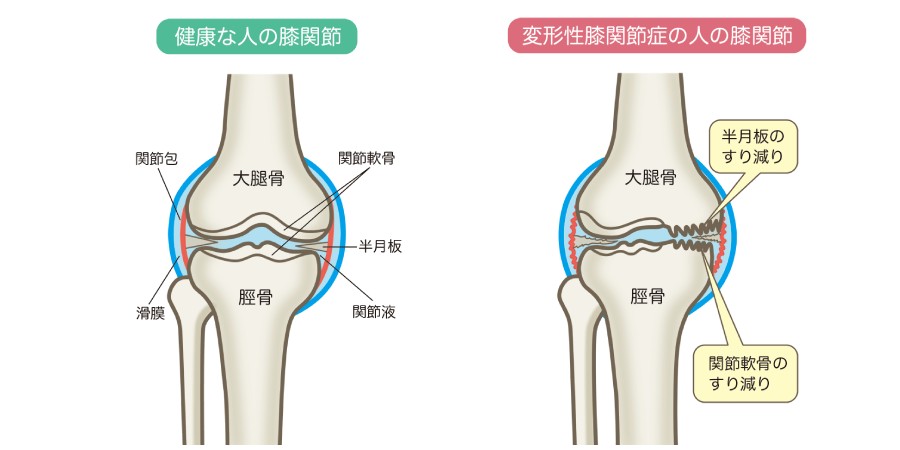 健康な人と変形性膝関節症の人の膝関節の違い