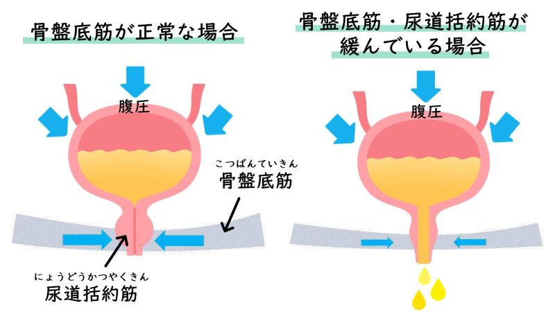 腹圧性尿失禁