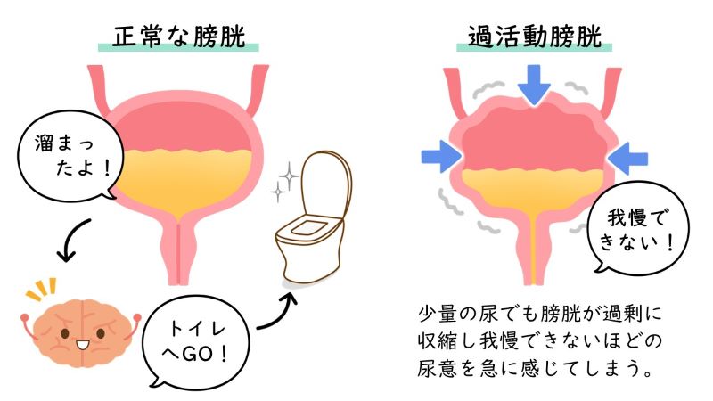 過活動膀胱