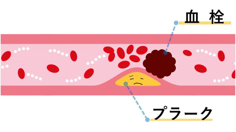 プラークで狭くなった血管と血栓